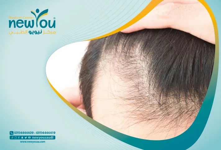 علاج الصلع عند الرجال تعرف عليه من خلال مركزنا الطبي في السعودية | نيويو