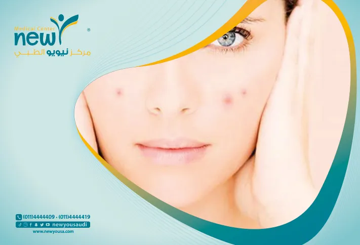 علاج حب الشباب و كل ما تريد معرفته عنه من خلال مركزنا الطبي في السعودية | نيويو