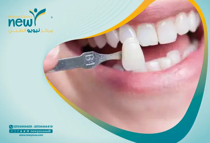 كسوة الاسنان