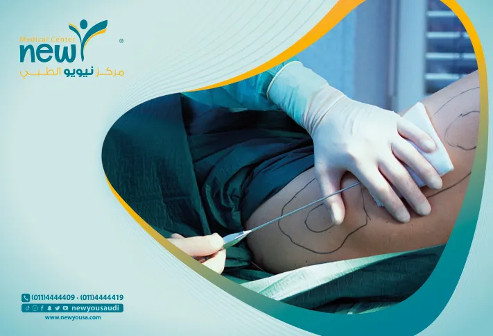 عملية شفط الدهون تعرف عليه من خلال مركزنا الطبي في السعودية | نيويو