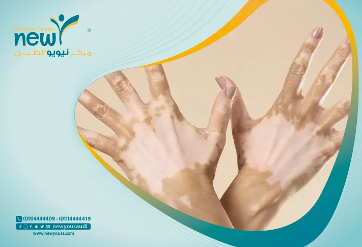 البهاق تعرف عليه من خلال مركزنا الطبي في السعودية | نيويو