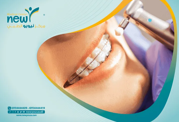 المواد المركبة بدبلة الحشوات كل ما تريد معرفته عنها من خلال مركزنا الطبي في السعودية | نيويو