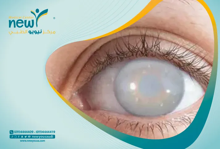 علاج الماء البيضاء في العين بالأعشاب ممكن حقًّا؟ - نيويو