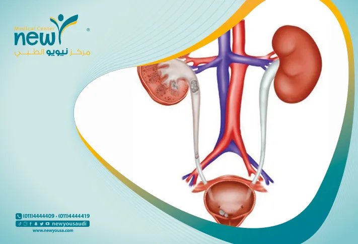 العيوب الخلقية في المسالك البولية