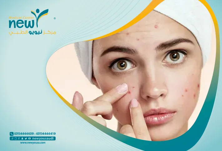 انواع حبوب الوجه تعرف عليه من خلال مركزنا الطبي في السعودية | نيويو