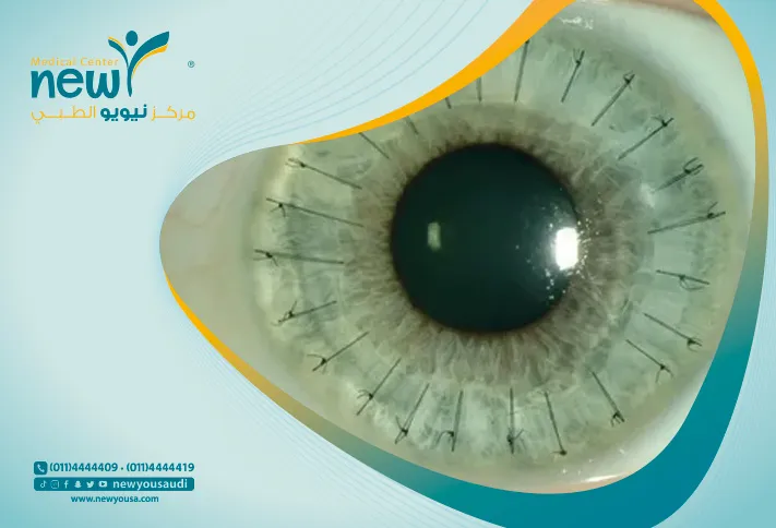 عملية زراعة القرنية كل ما تريد معرفته عنها من خلال مركزنا الطبي في السعودية | نيويو