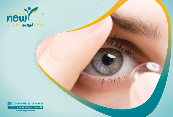 العدسات اللاصقة كل ما تريد معرفته عنها من خلال مركزنا الطبي في السعودية | نيويو