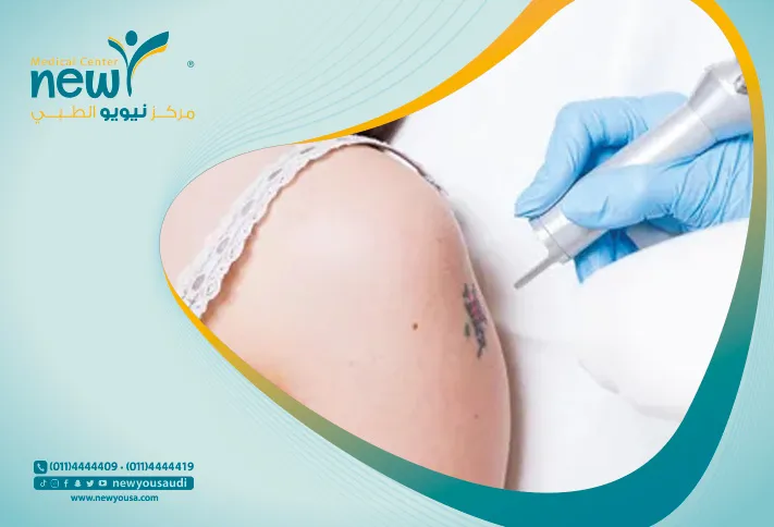 إزالة الوشم بالليزر تعرف عليه من خلال مركزنا الطبي في السعودية | نيويو