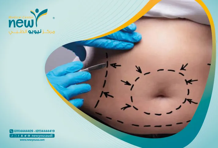 عملية شفط الدهون بالليزر كل ما تريد معرفته عنها من خلال مركزنا الطبي في السعودية | نيويو