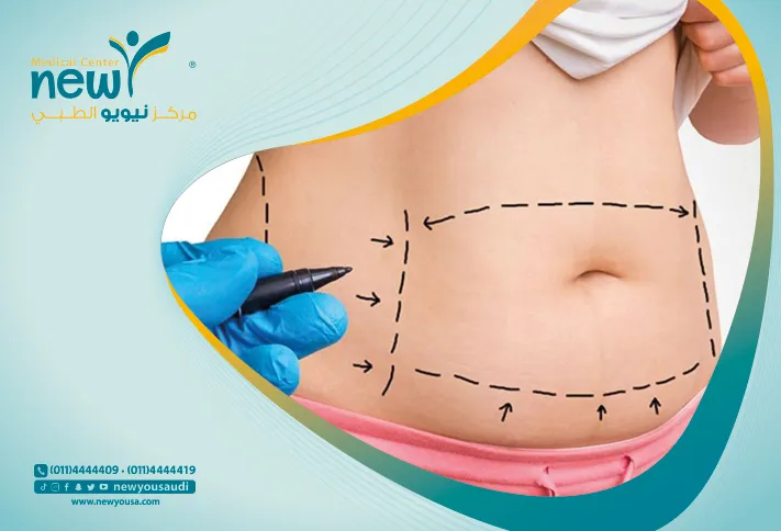 شد البطن كل ما تريد معرفته عنه من خلال مركزنا الطبي في السعودية | نيويو
