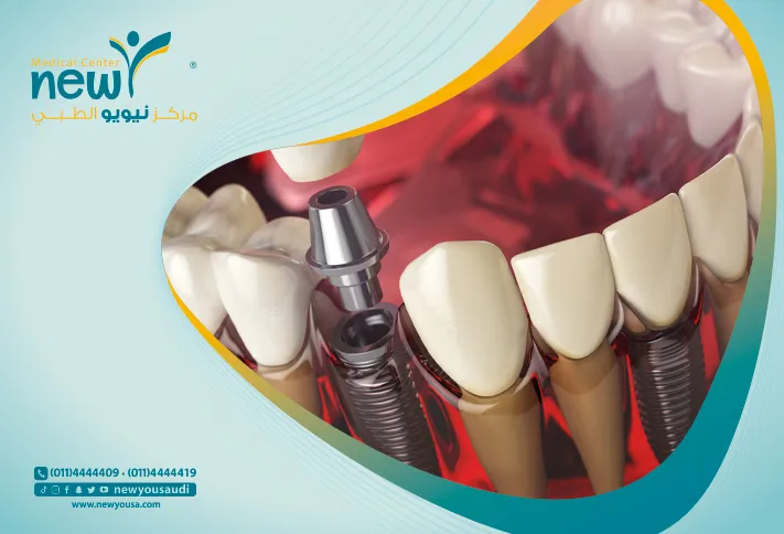علاجات زراعة الأسنان تعرف عليها من خلال مركزنا الطبي في السعودية | نيويو