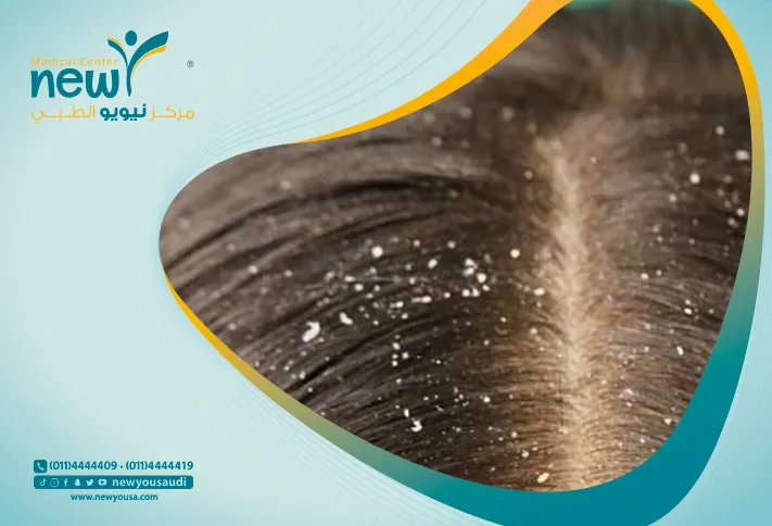ازالة القشرة من الشعر امر مرهق للكثير خاصتا الشباب في عمر المراهقة