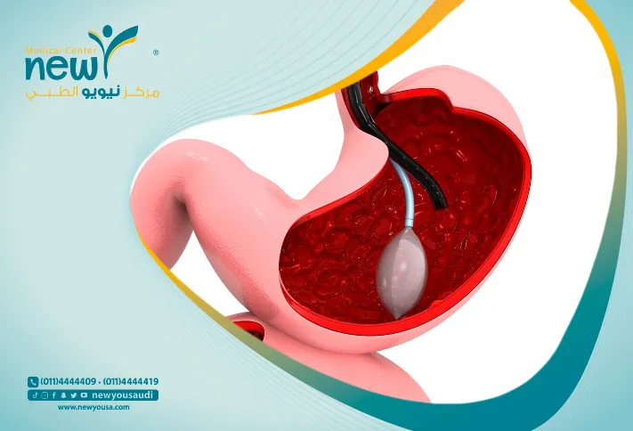 فوائد البالون للمعدة