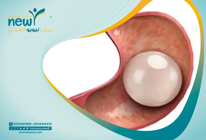 أهم شيء يجب معرفته عن تكلفة البالون المبرمج من خلال مراكزنا الطبية