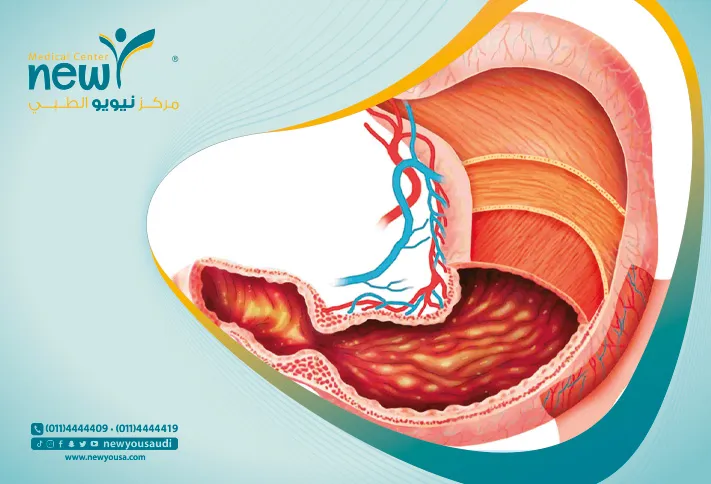 عملية الكرمشة في السعودية سعر كرمشة المعدة كل ما عليك معرفته