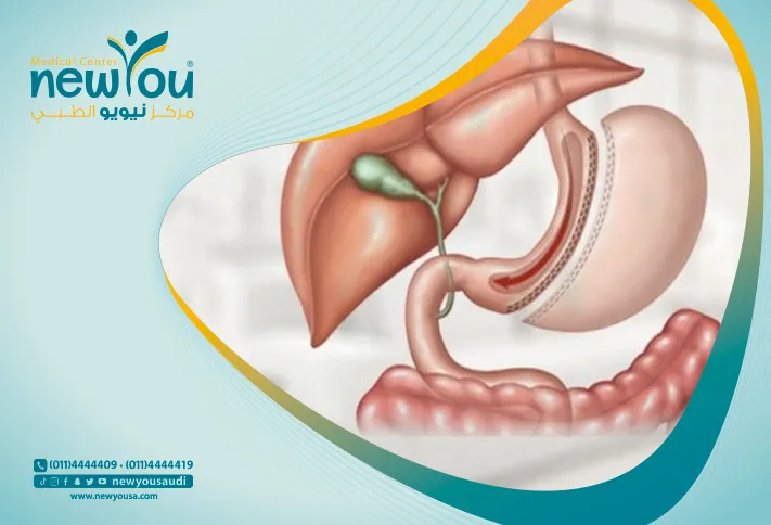 عملية تكميم المعدة في السعودية سعر تكميم المعدة كل ما عليك معرفته