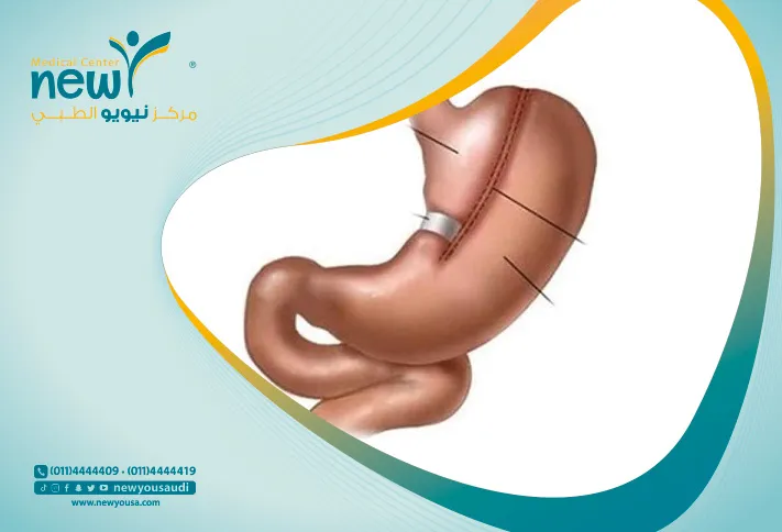سعر عملية كرمشة المعدة في السعودية سعر كرمشة المعدة كل ما عليك معرفته