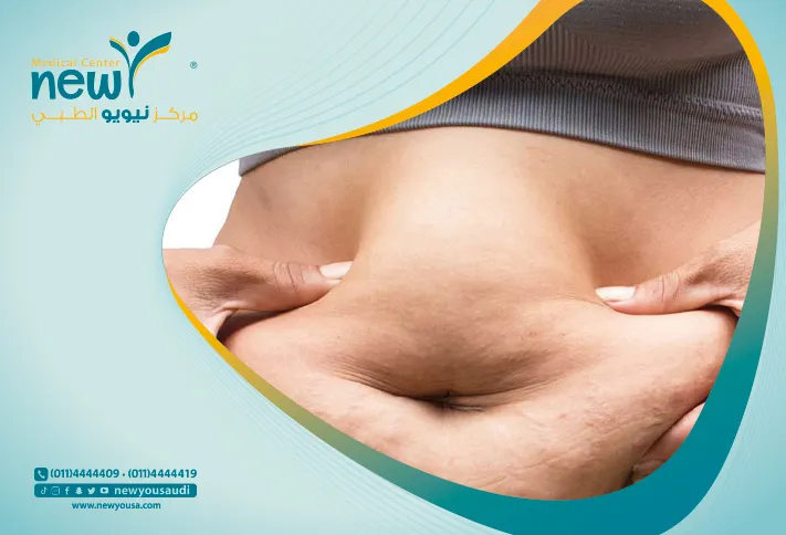 اسباب ترهلات البطن