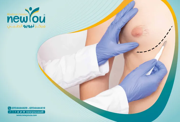 ما هي ظاهرة التثدي وكيف يمكن حل هذه المشكلة؟