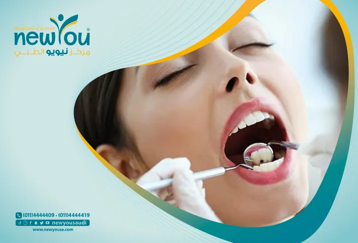 علاج التسوس كل ما تريد معرفته عنه من خلال مركزنا الطبي في السعودية | نيويو