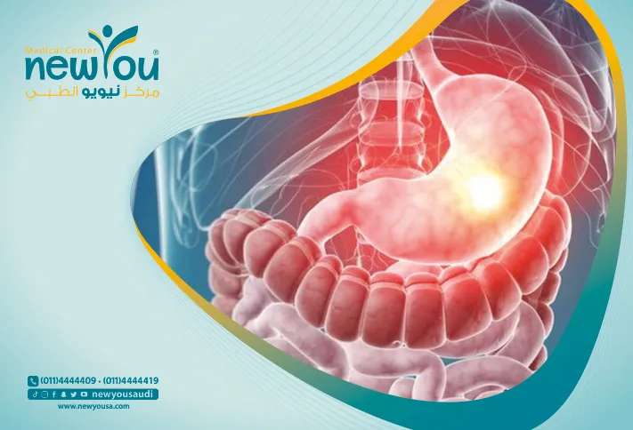 التكميم في الرياض في السعودية سعر عملية التكميم كل ما عليك معرفته