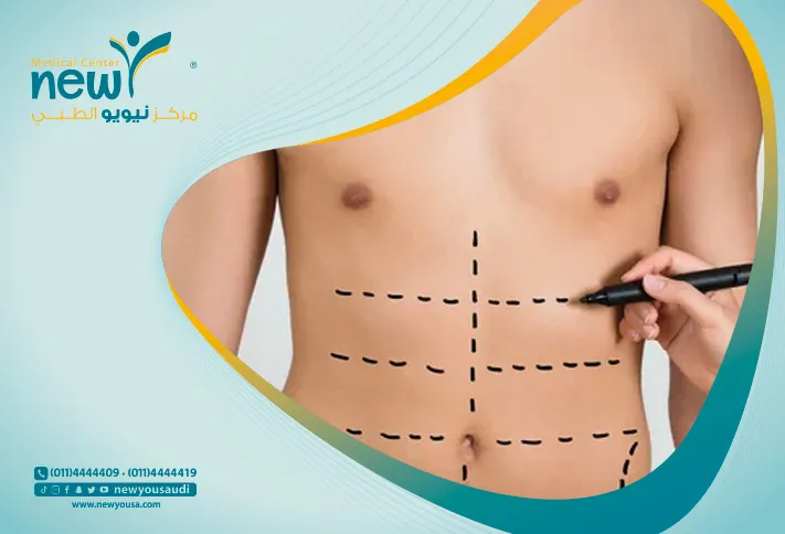 عمليات شد البطن كل ما تريد معرفته عنه من خلال مركزنا الطبي في السعودية | نيويو