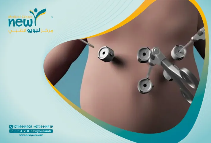 عملية تكميم المعدة في السعودية سعر تكميم المعدة كل ما عليك معرفته
