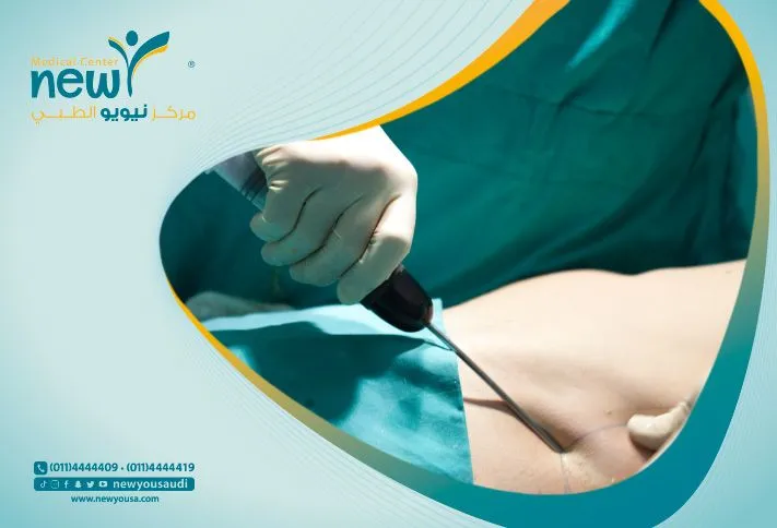 تجربتي مع عملية شفط الدهون: من القرار إلى النتائج