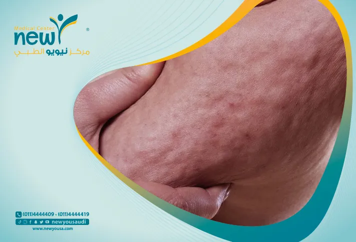 السيلوليت كل ما تريد معرفته عنها من خلال مركزنا الطبي في السعودية | نيويو