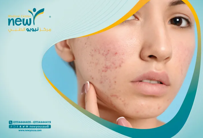 جهاز الديرما بن تعرف عليه من خلال مركزنا الطبي في السعودية | نيويو