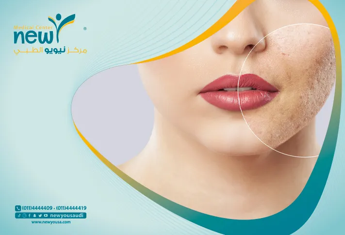 أنواع الندبات تعرف عليه من خلال مركزنا الطبي في السعودية | نيويو