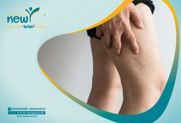 الدوالي عند الرجال تعرف عليه من خلال مركزنا الطبي في السعودية | نيويو
