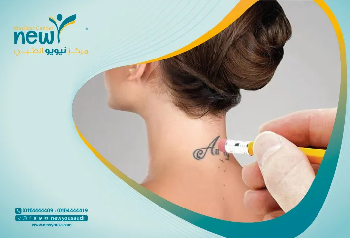 ازالة التاتو تعرف عليه من خلال مركزنا الطبي في السعودية | نيويو