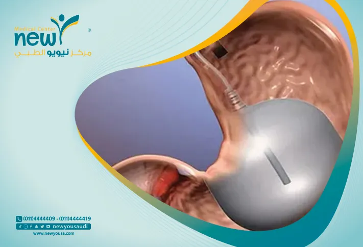 عملية البالون الذكي للحصول علي جسم مثالي | مركز نيويو الطبي