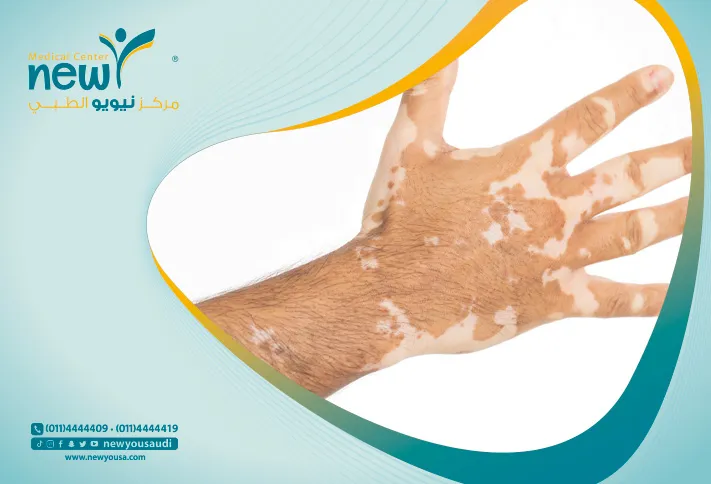 افضل طبيب بهاق في السعودية يعرض عليكم اعراض البهاق واسبابه وبعض النصائح