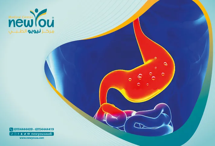 حلقة المعدة كل ما تريدي معرفته عنها من خلال مركزنا الطبي في السعودية | نيويو