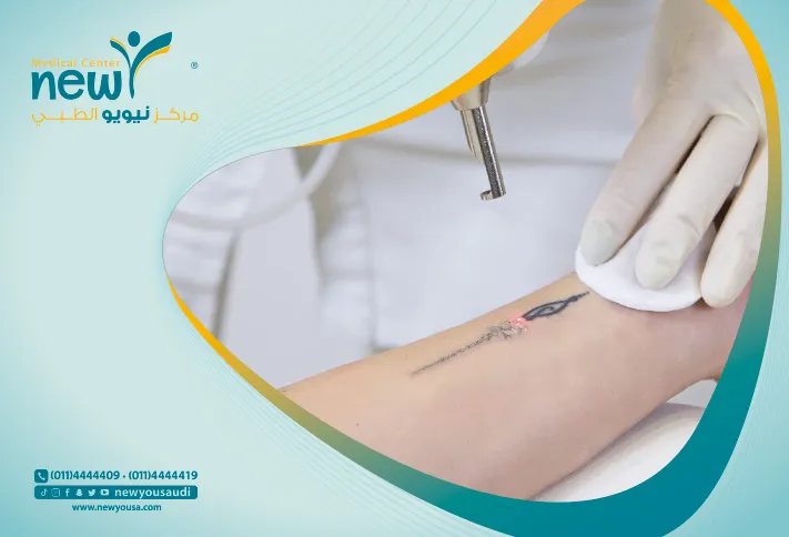 عملية إزالة التاتو تعرف عليه من خلال مركزنا الطبي في السعودية | نيويو