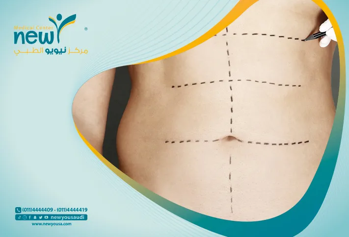 أسئلة شائعة حول عمليات شد البطن