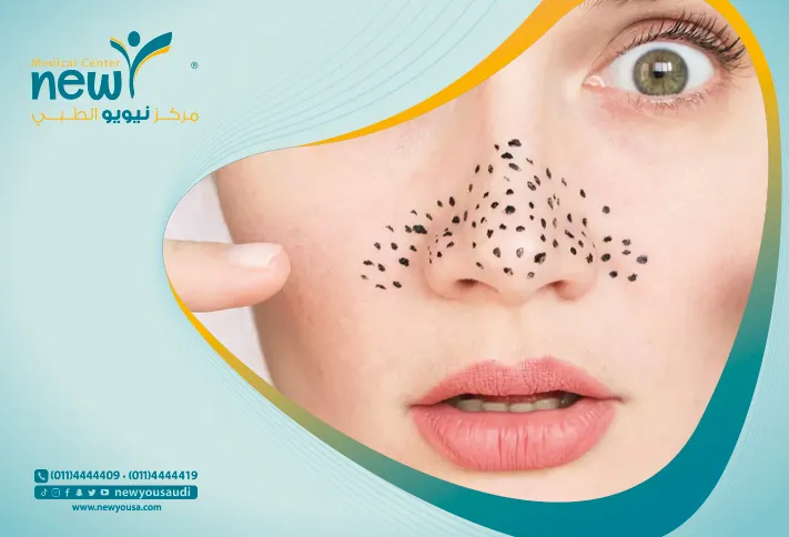 أسباب البثور السوداء تعرف عليه من خلال مركزنا الطبي في السعودية | نيويو