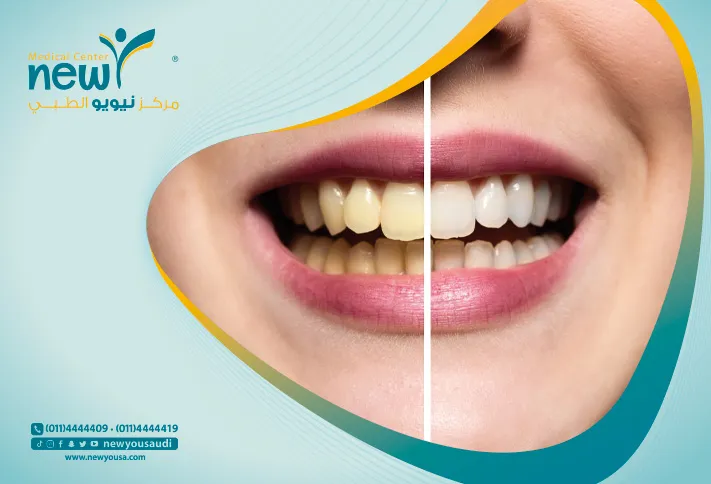 علاج تسوس الاسنان تعرف عليه من خلال مركزنا الطبي في السعودية | نيويو