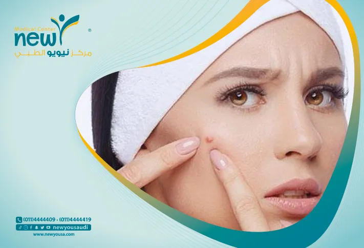 حب الشباب كل ما تريد معرفته عنه من خلال مركزنا الطبي في السعودية | نيويو