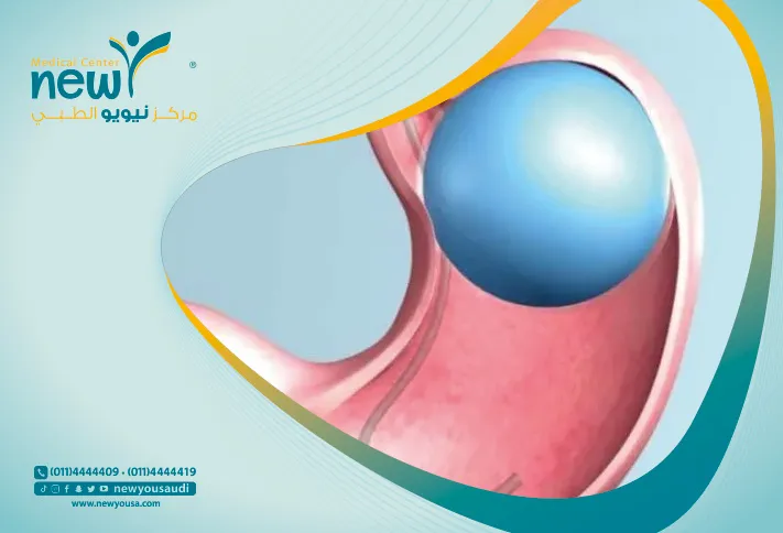تعرف علي بالون المعدة في السعودية مركز نيويو الطبي