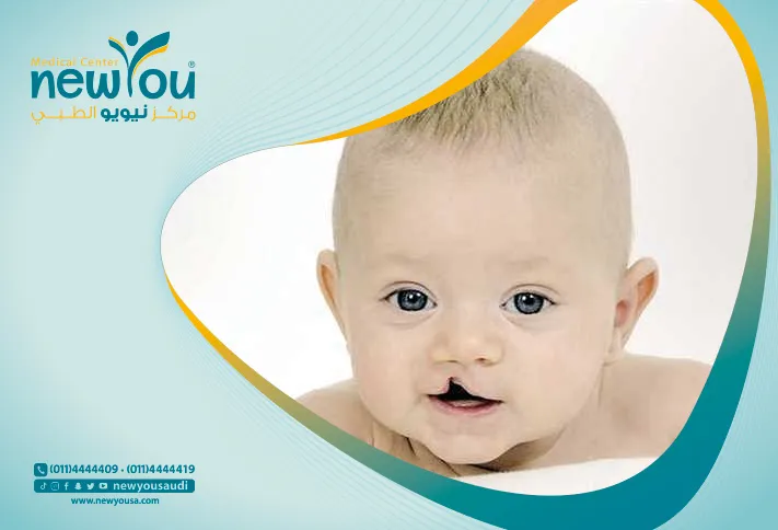 مشاكل الشفة الارنبية كل ما تريد معرفته عنها من خلال مركزنا الطبي في السعودية | نيويو