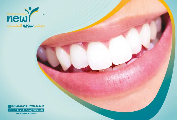 تبييض الاسنان باستخدام الليزر تعرف عليه من خلال مركزنا الطبي في السعودية | نيويو
