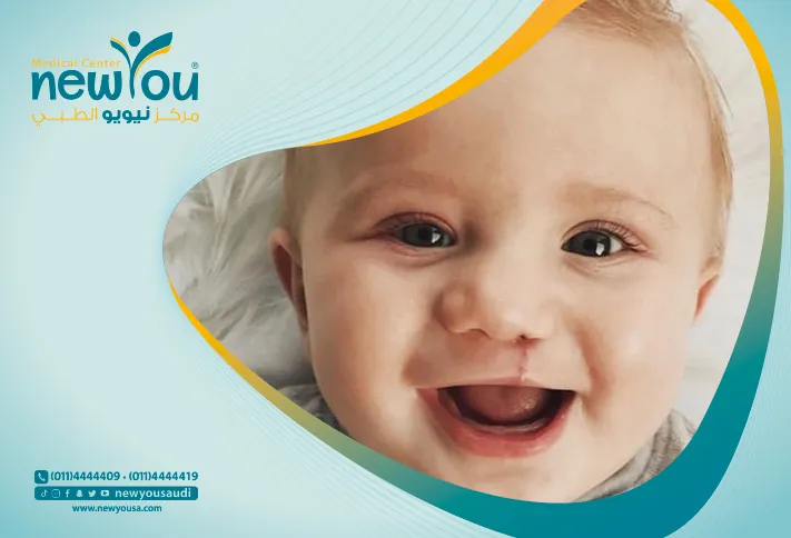 تجميل الشفة الارنبية كل ما تريدي معرفته عنها من خلال مركزنا الطبي في السعودية | نيويو