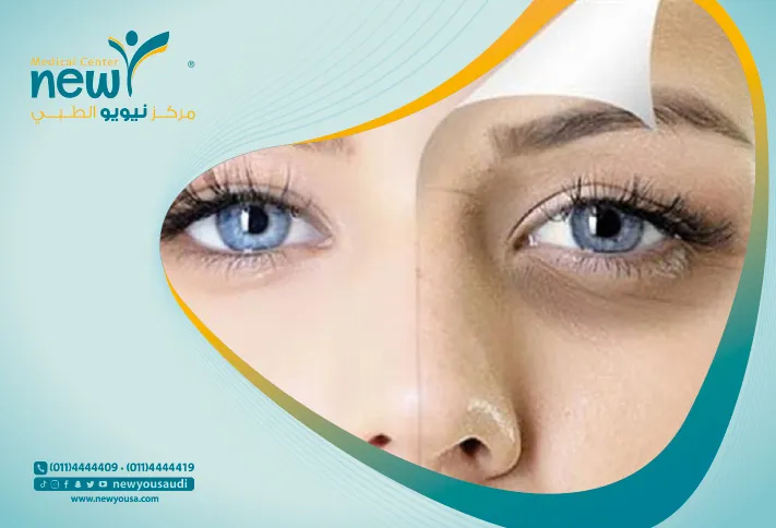 الهالات السوداء كل ما تريد معرفته عنها من خلال مركزنا الطبي في السعودية | نيويو