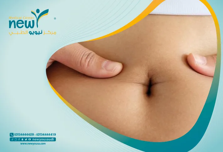 شد البطن بعد الولادة كل ما تريدي معرفته عنه من خلال مركزنا الطبي في السعودية | نيويو
