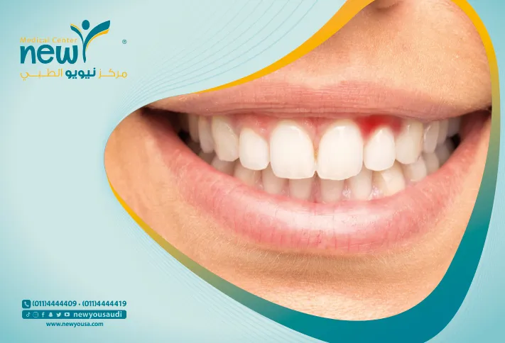 أدوية علاج جيوب اللثة تعرف عليه من خلال مركزنا الطبي في السعودية | نيويو