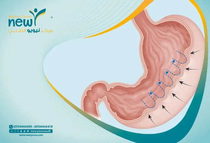 تجربتي مع كرمشة المعدة | البروفيسور عائض القحطاني