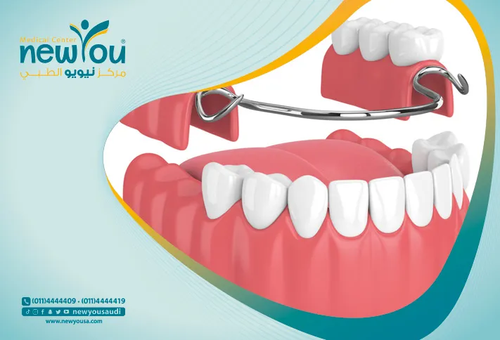 لاصق طقم الأسنان تعرف عليه من خلال مركزنا الطبي في السعودية | نيويو